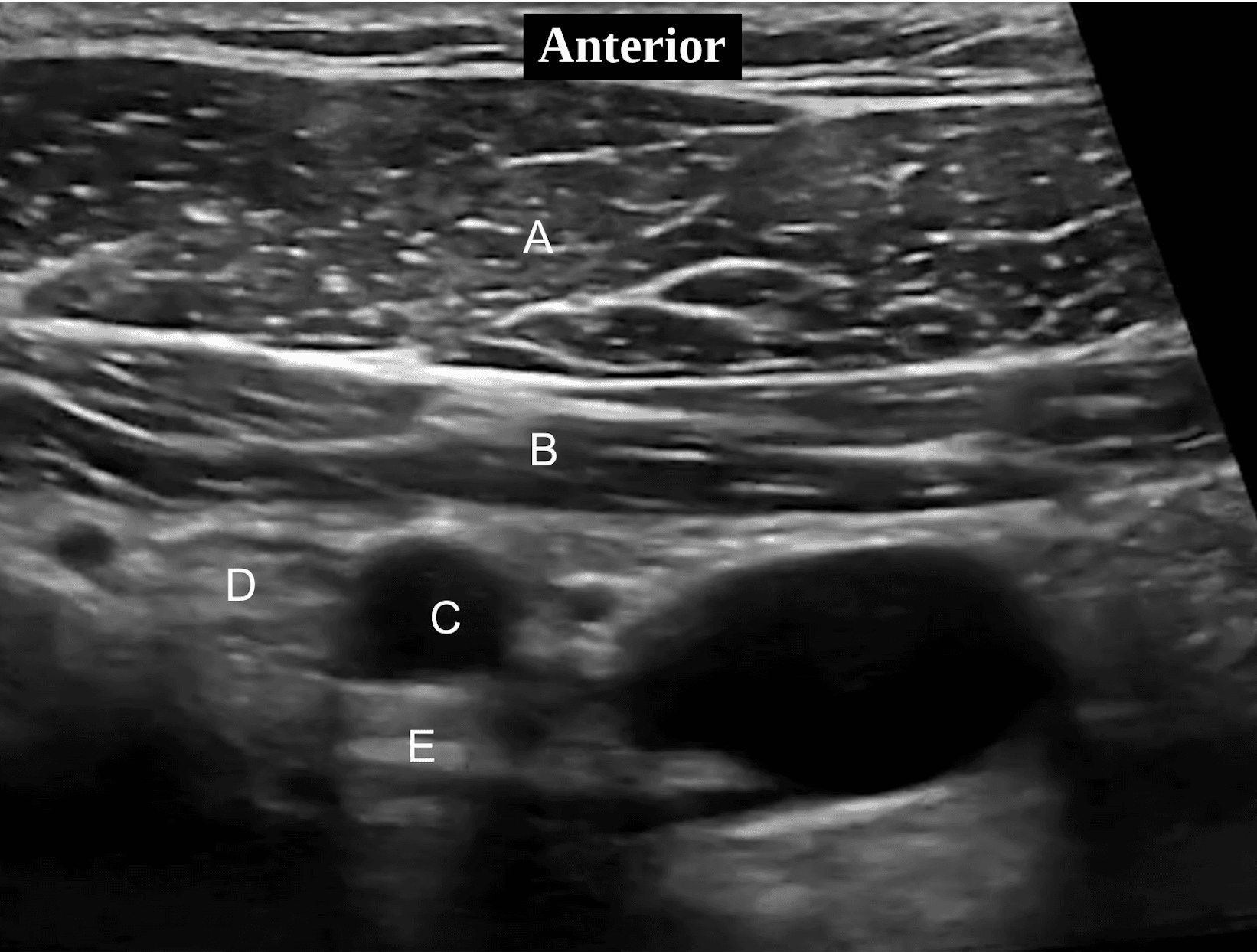 ITE Exam anterior neck ultrasound view question preview